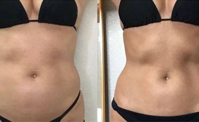 Body shaping treatment result